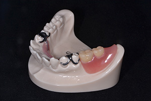 保険診療の義歯